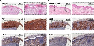 Untargeted metabolomics yields insight into extramammary Paget’s disease mechanisms